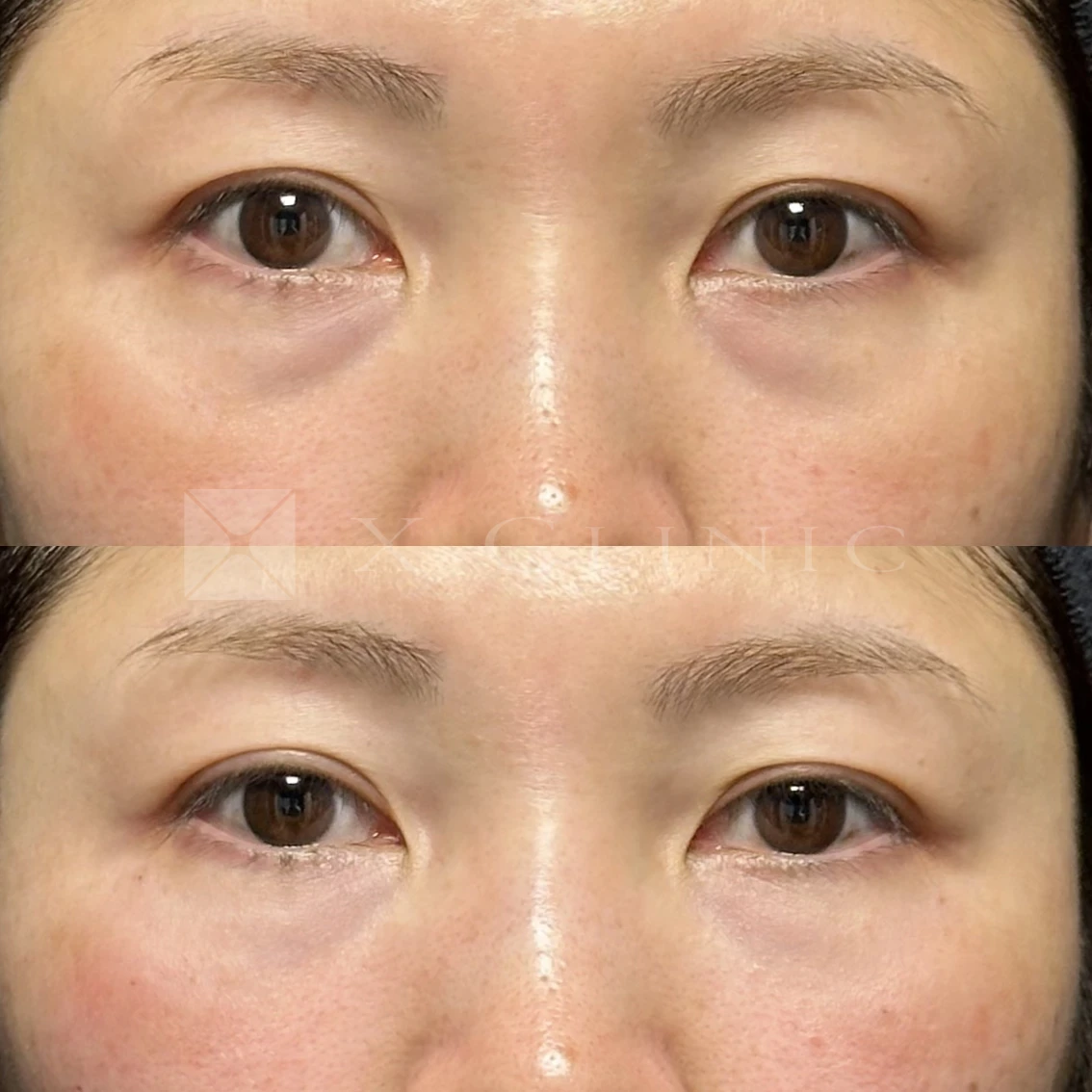症5 Before