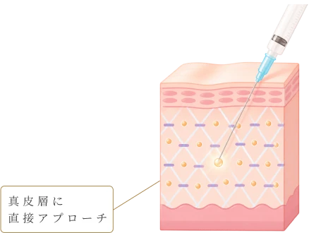 真皮層へのアプローチ